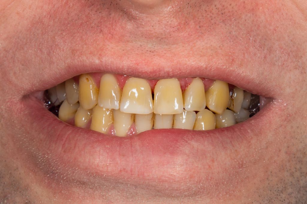 yellowing teeth