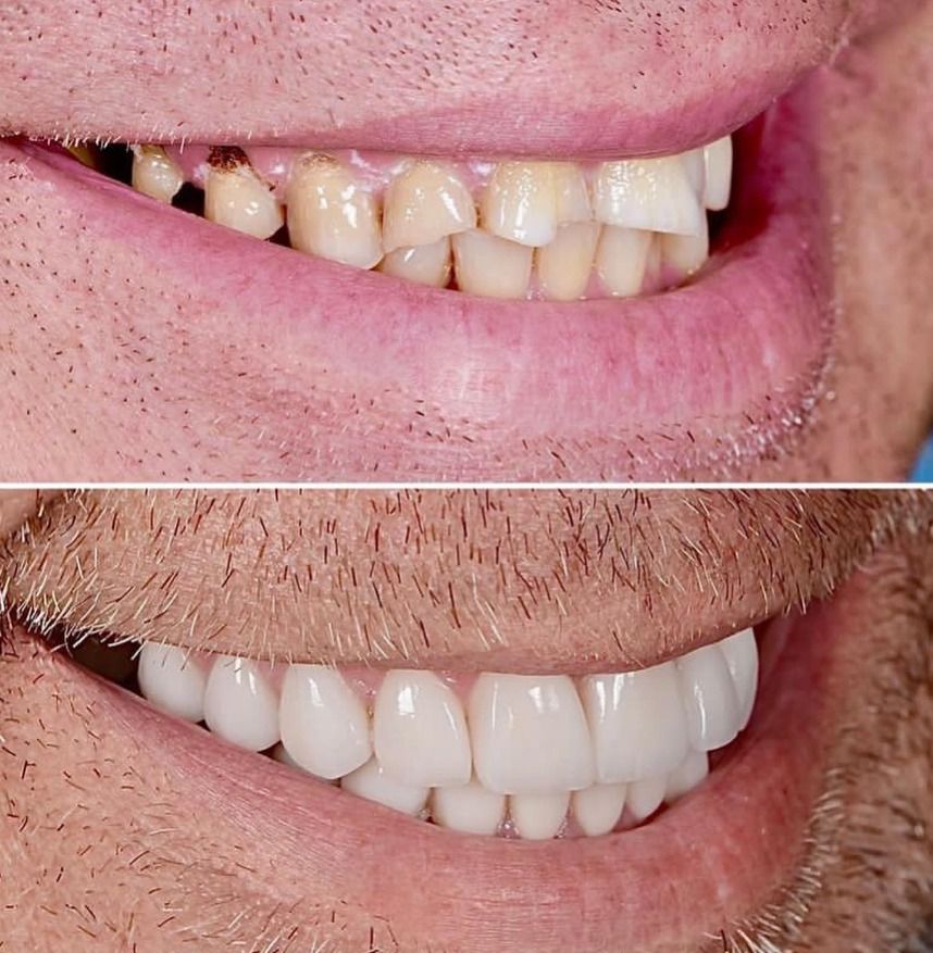 before and after implants and veneers