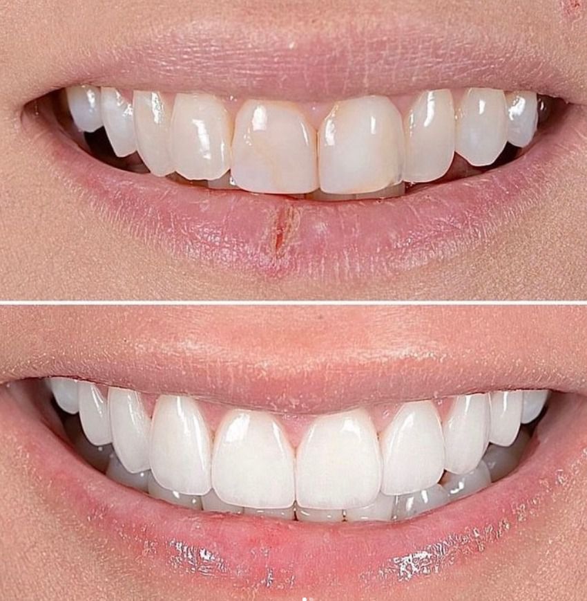 before and after superthin veneers