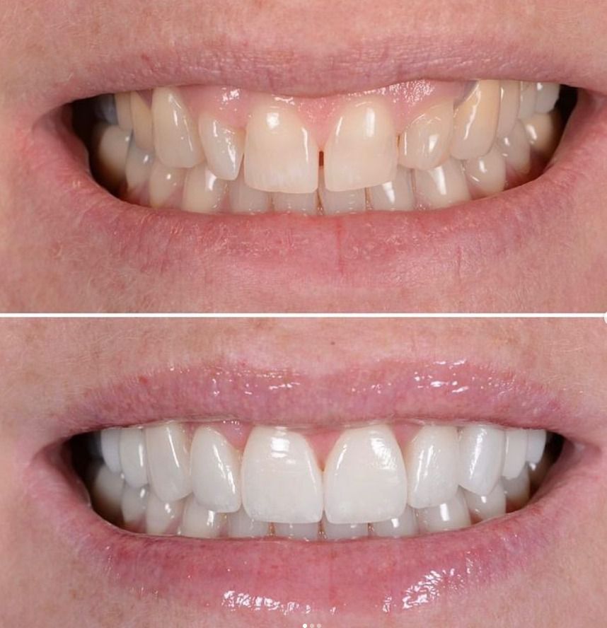 before and after ultrathin veneers