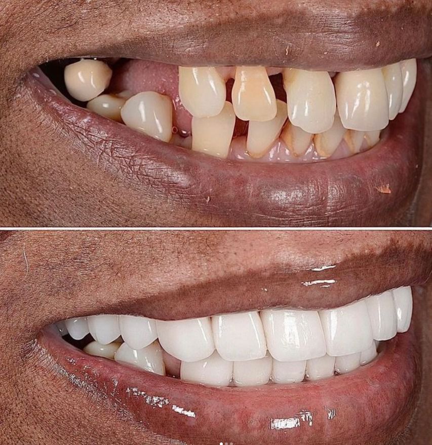 porcelain veneers and implants before and after