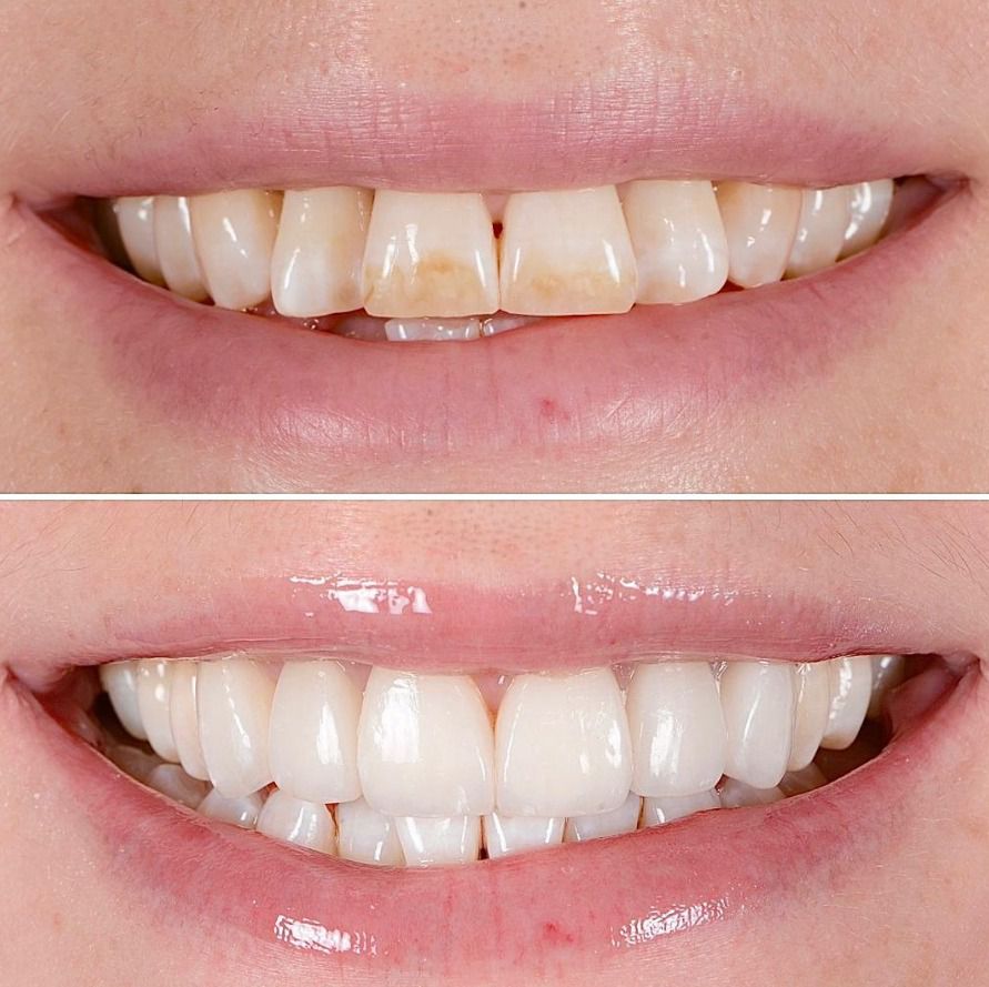 ultrathin veneers before and after