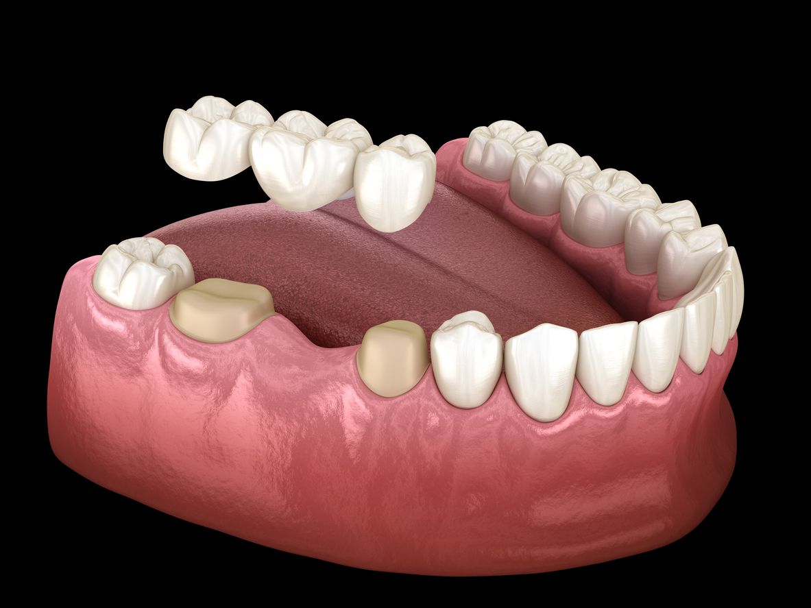dental bridge image