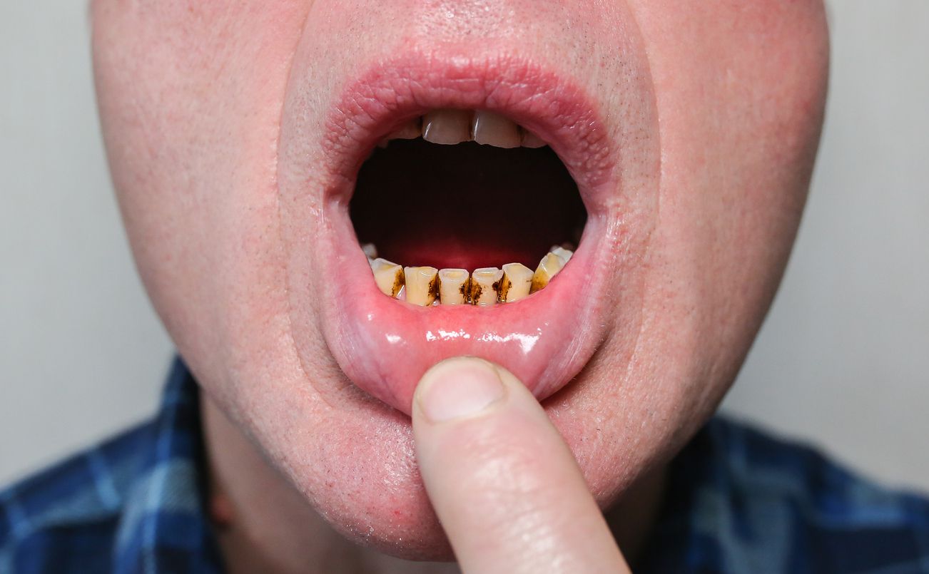 picture of black teeth